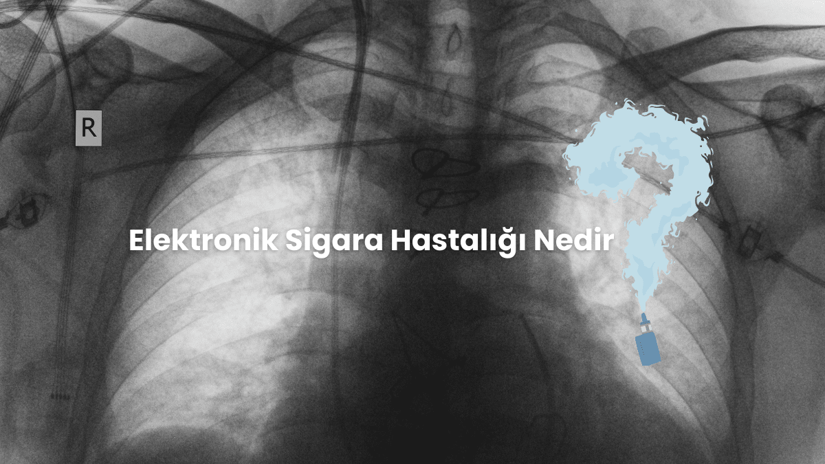 Elektronik Sigara Hastalığı Bulundu:  EVALI